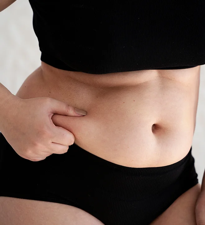 diastasis-abdominal1