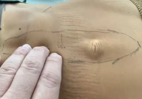 Cirugía Diástasis Abdominal en Panamá