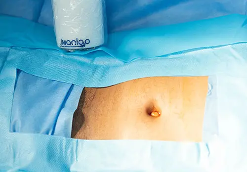 Cirugía Hernia inguinal en Panamá