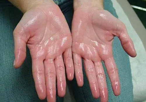 Hiperhidrosis en Panamá